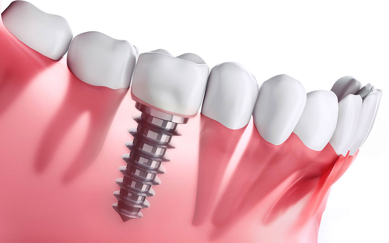zubni-implantati-dr-Djuric